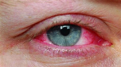A­r­a­ş­t­ı­r­m­a­l­a­r­a­ ­G­ö­r­e­ ­K­o­r­o­n­a­v­i­r­ü­s­,­ ­G­ö­z­l­e­r­d­e­ ­2­0­ ­G­ü­n­d­e­n­ ­F­a­z­l­a­ ­Y­a­ş­ı­y­o­r­